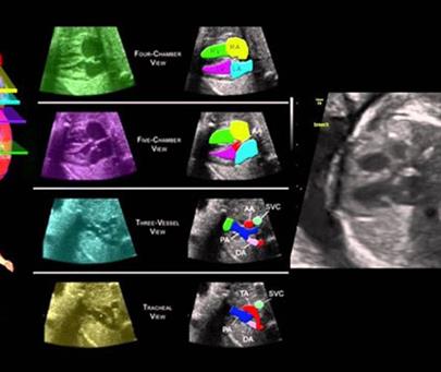 Color Doppler ultrasound (third trimester of pregnancy)